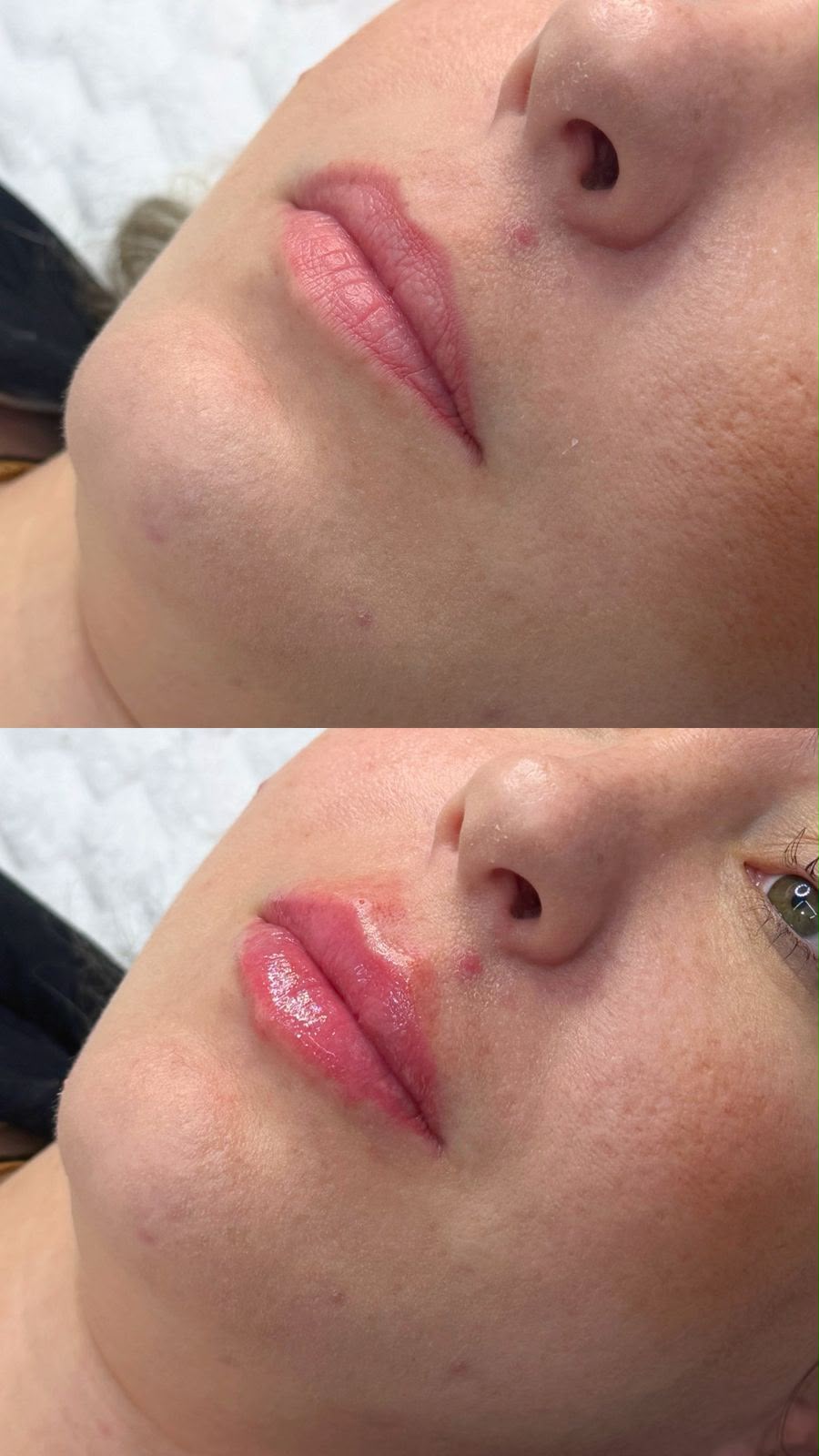 Foto antes do preenchimento labial: os lábios na sua forma natural